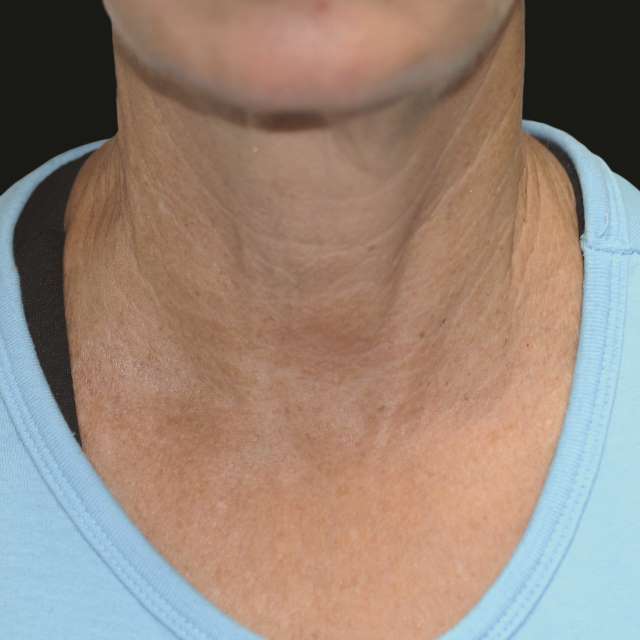 Exilis Elite – Θερμολιπόλυση για λιποδιάλυση και σύσφιξη