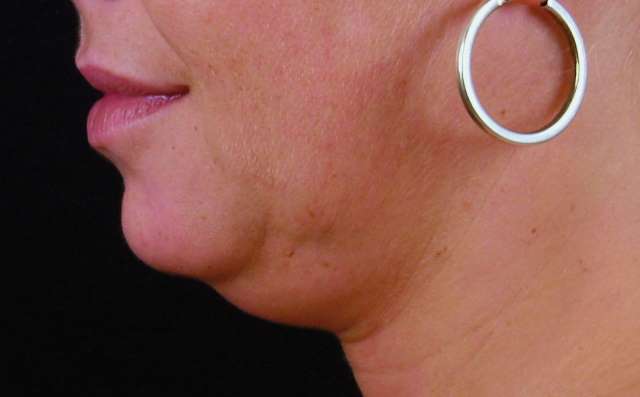 Exilis Elite – Θερμολιπόλυση για λιποδιάλυση και σύσφιξη
