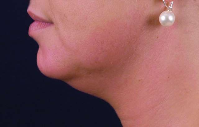 Exilis Elite – Θερμολιπόλυση για λιποδιάλυση και σύσφιξη