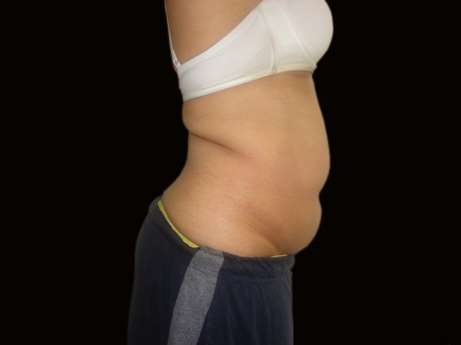 Exilis Elite – Θερμολιπόλυση για λιποδιάλυση και σύσφιξη