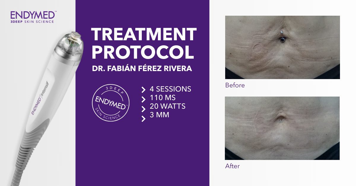 INTENSIF – RF Microneedling